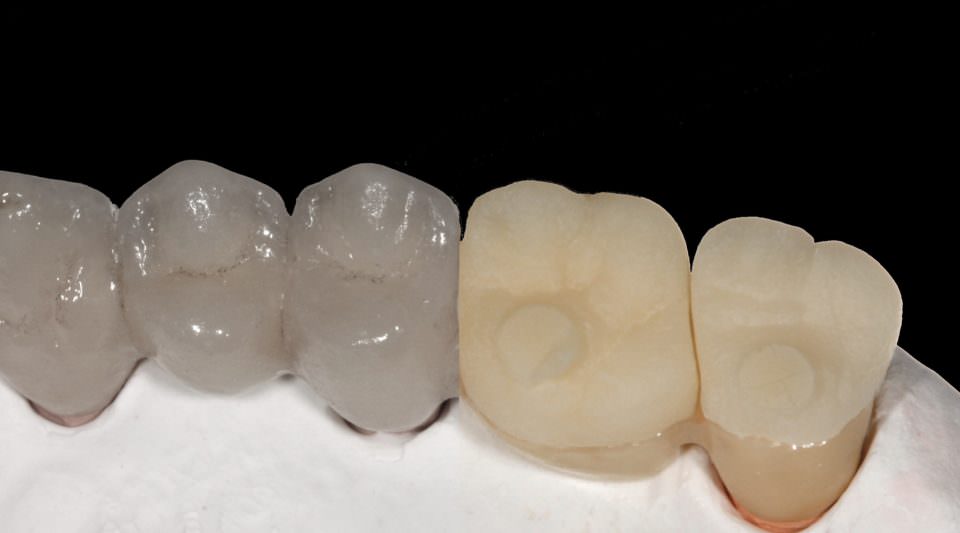 Preventing Ceramic Chipping in Dental Restorations