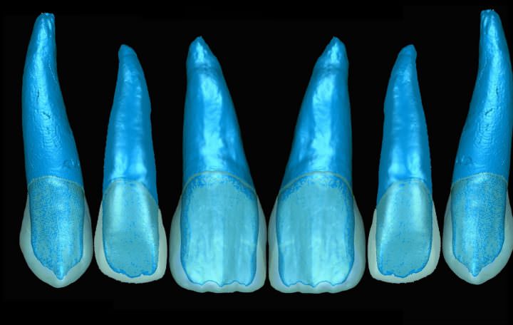 Digitally Produced Dentin Cores for Multilayer Anterior Restorations