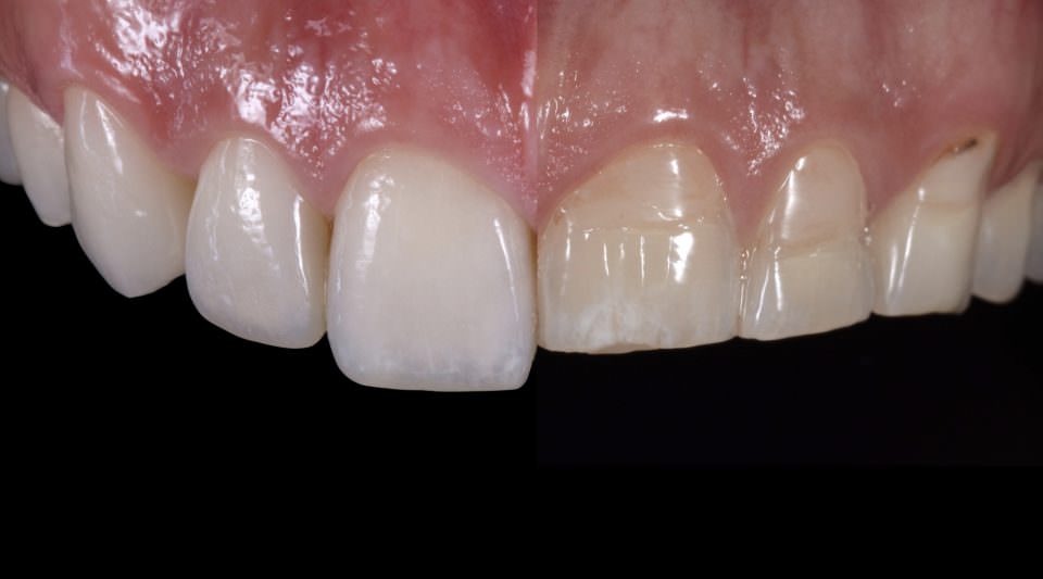 Dental Restoration Step by Step