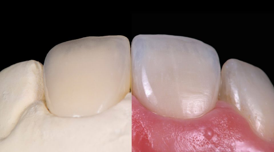 Ceramic Veneer (Anterior Dental Restoration)