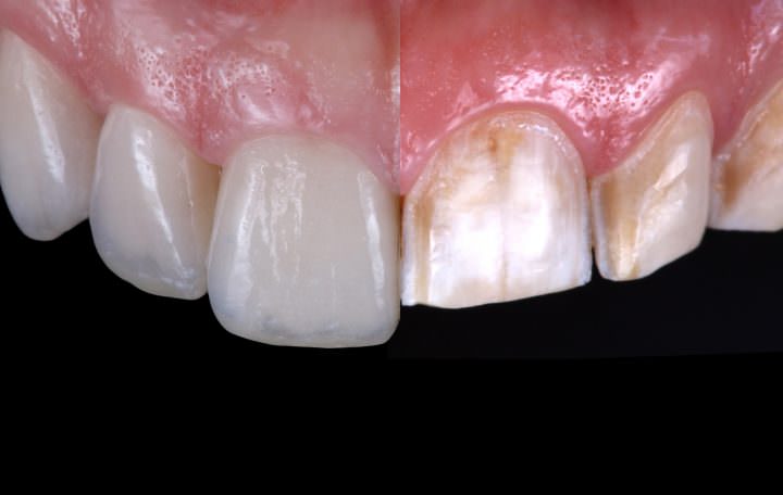 Porcelain veneers and CAD:CAM polymer restorations for amelogenesis imperfecta