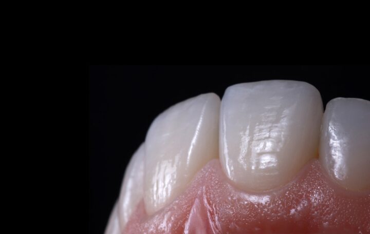 anterior tooth restoration.055