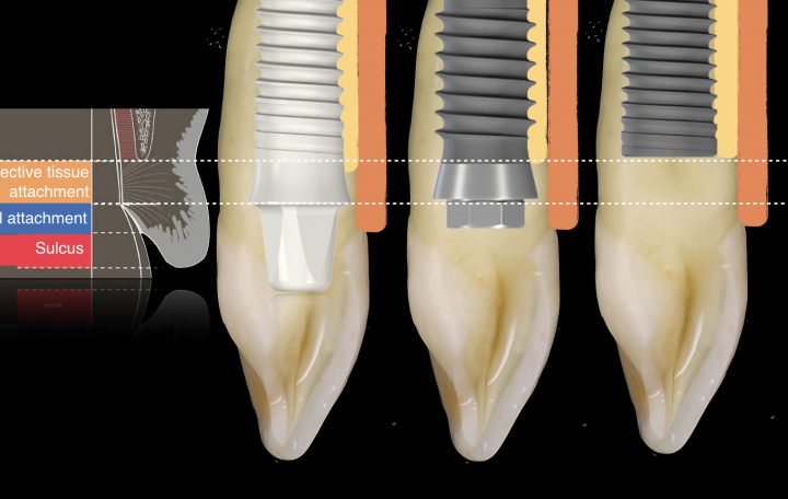 metal-free implant-supported single-tooth restorations