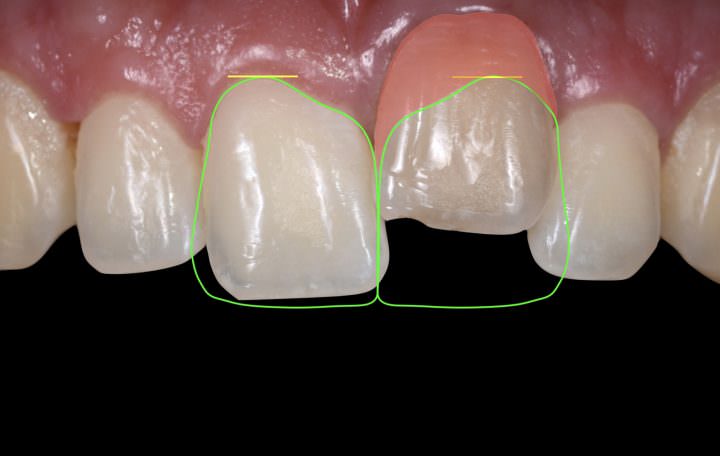Ankylosed tooth - Minimally Invasive Treatment with a Ceramic Veneer